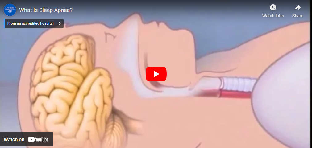 Sleep apnea - how it happens video cover