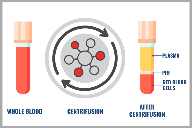 graphic showing the process of obtaining PRF using blood and centrifusion