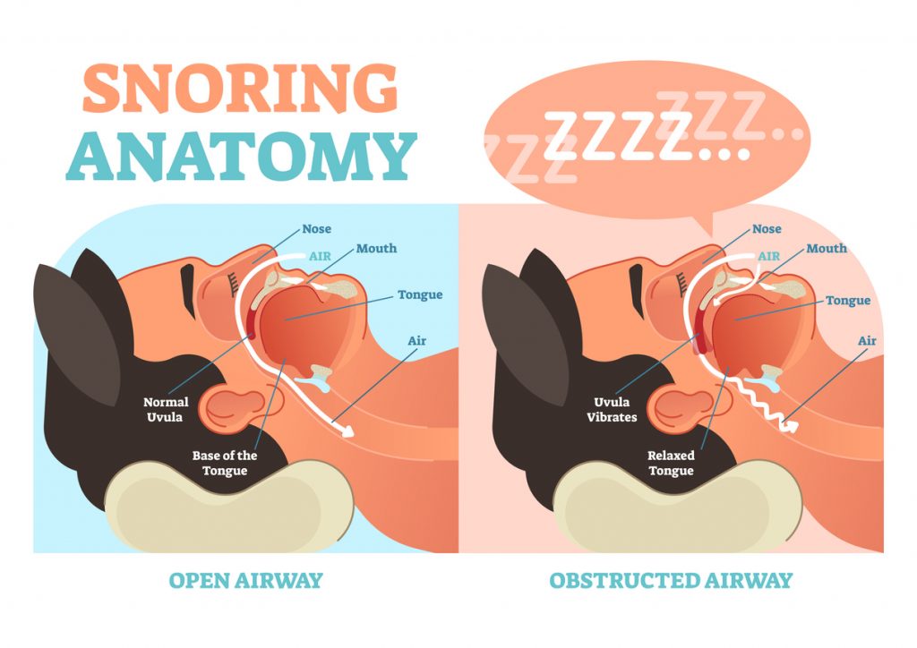 Anatomy of snoring: open airway vs obstructed airway